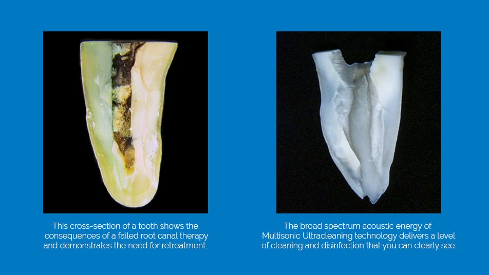 comparisonsonic2 Advanced Endodontics, PC